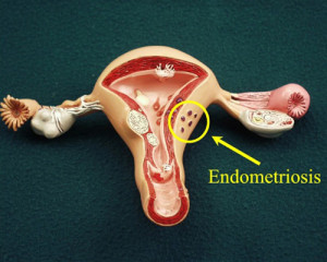 Эндометриоз